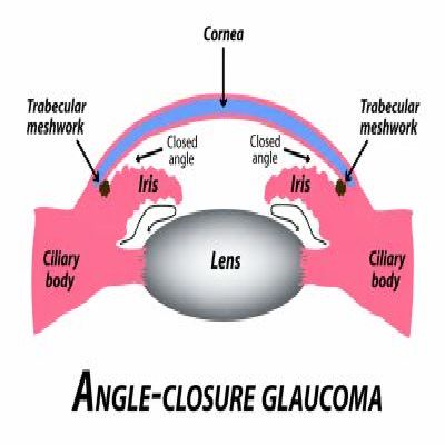 MICS procedure